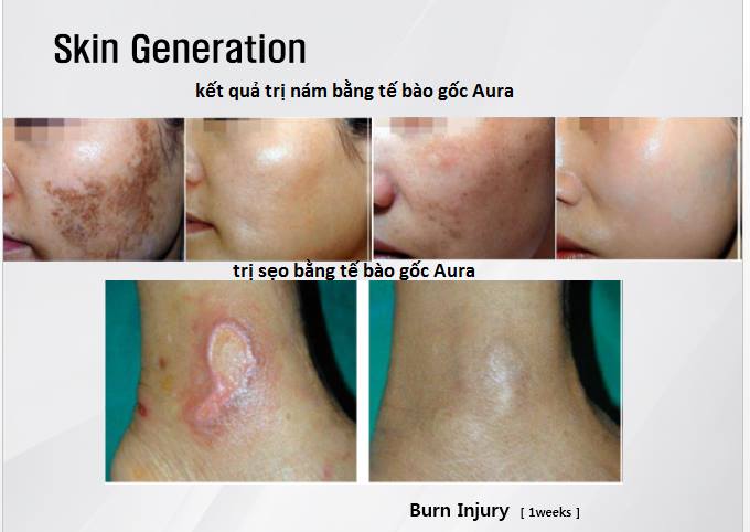 tế bào gốc điều trị nám, làm mờ sẹo aura hàn quốc
